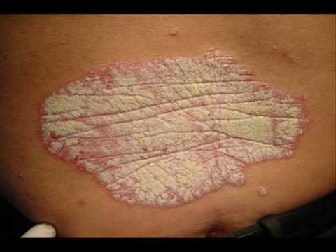 psoriasis skin disease treatment in hindi)