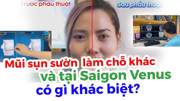 Mũi Sửa Nhiều Lần Nhưng Vẫn Lệch Khắc Phục Nhờ Công Nghệ Nâng Mũi 3D Signature