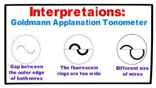 Interpretations- Goldmann Applanation Tonometer.