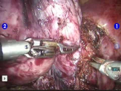 surgery 10 cm cervical fibroid dr luthringer youtube