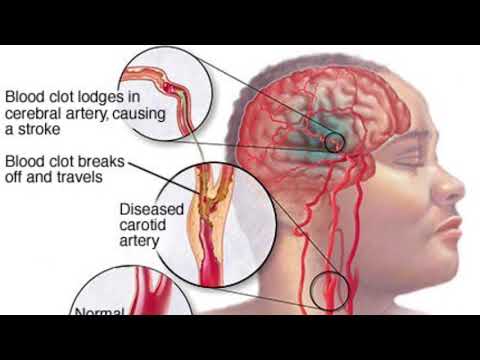 سکته های مغزی انواع عوامل زمينه ساز پيشگيرى و اصول درمانى آنها
