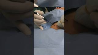 Thyroid nodule treatment without surgery | With a small needle - Scarless | Dr. Gaurav Gangwani