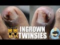 CRAZY "TWINNING" INFECTED INGROWN TOENAIL REMOVAL