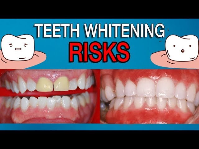 do teeth whitening strips work on fillings