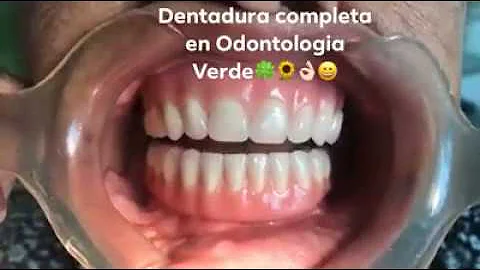 ¿Cómo se llama una dentadura postiza completa?