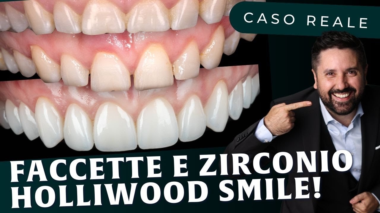 Holliwood Smile Dottor Palmas, Faccette e corone Zirconio, Emax Empress
