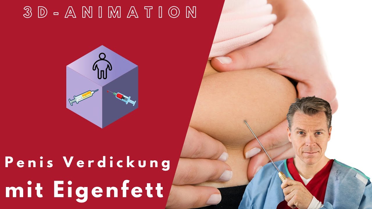 PENISVERDICKUNG Wie Wird Die OP Durchgef hrt Animationsvideo Dr penisverdickung-wie-wird-die-op-durchgef-hrt-animationsvideo-dr