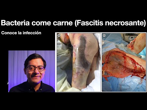 Video: Las Bacterias Carnívoras Se Comieron La Piel De La Mitad Del Cuerpo Del Hombre (¡Cuidado, Contenido Impactante! 18+)