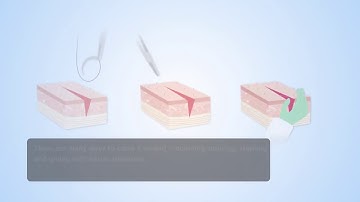 New tissue adhesive tape to replace sutures