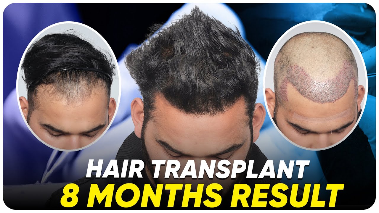 Hair Transplant in Chennai Best Results & Cost of Hair Transplant in