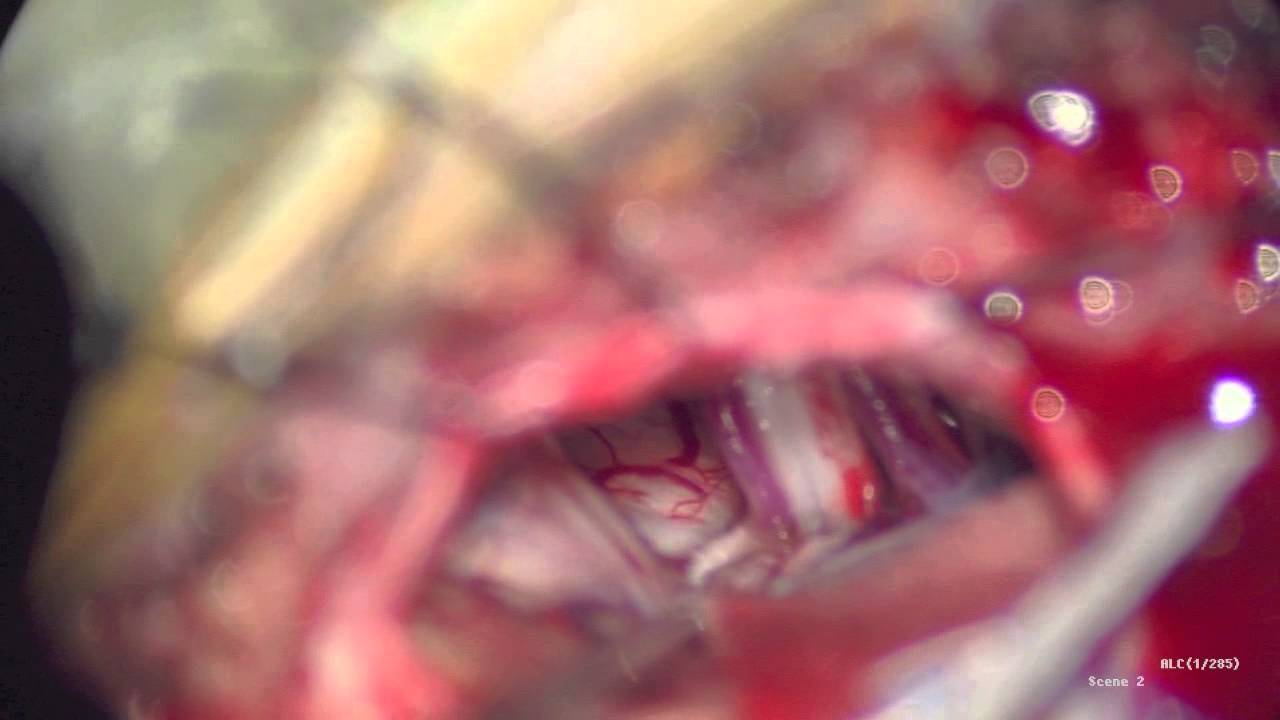 Retromastoid Craniotomy and Microvascular Decompression of Cranial Nerve 7 for Treatment of Hemifac camera iphone 8 plus apk