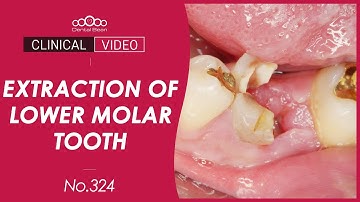 Immediate Implant Placement on Lower Molar Area [Dr. Cho Yongseok]