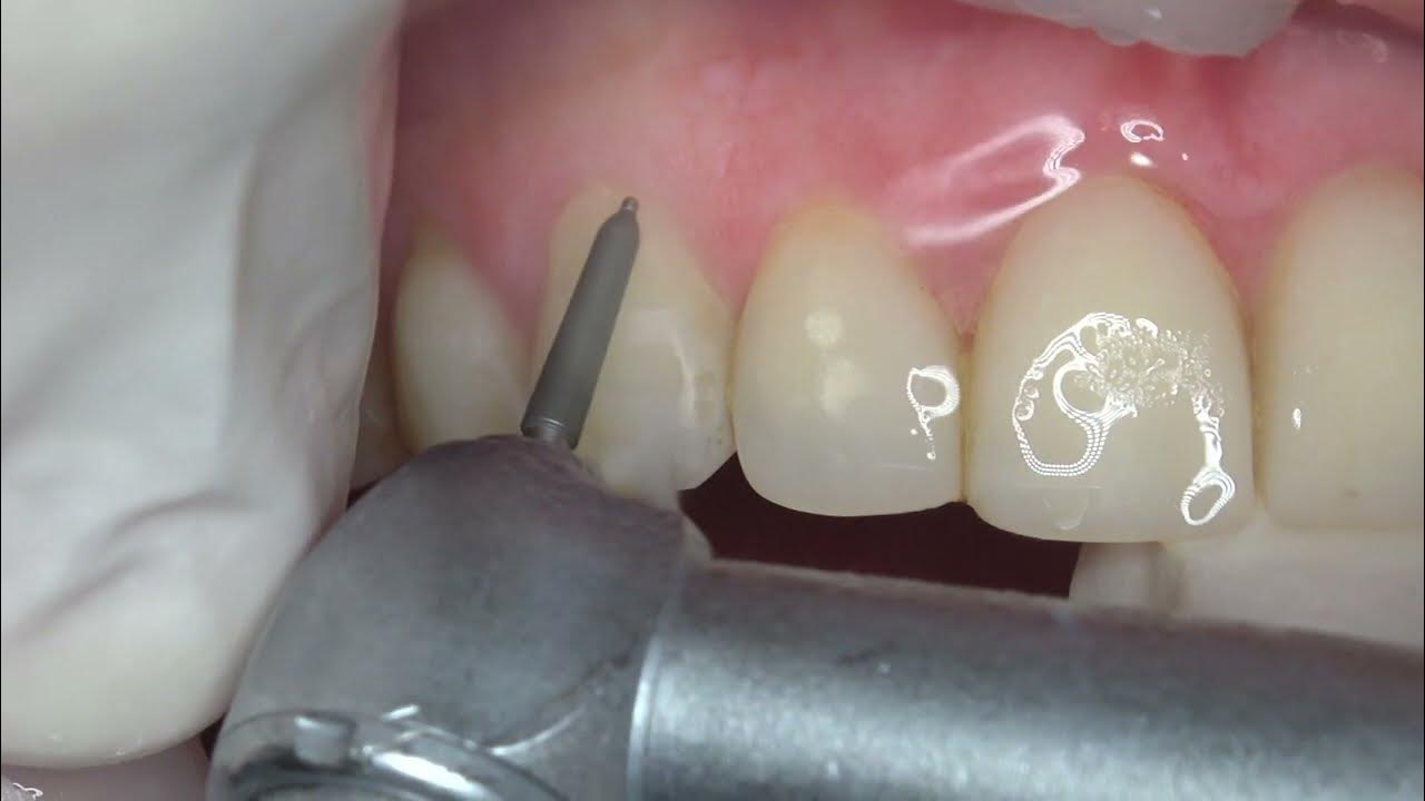 Tooth preparation Featheredge margin YouTube