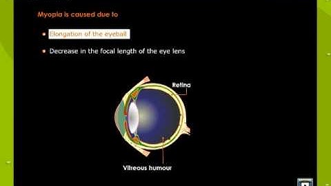 Myopia.