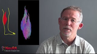 Rob Herbert Talks About Research Into Contractures