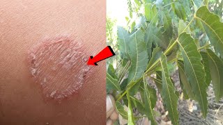 2-दन म दद खज खजल क 100% दस इलजDad Khaj Khujli Ka Ilaj