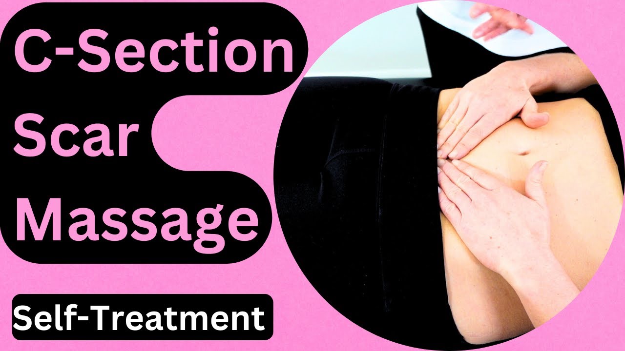 How to Massage your C-section Scar: Easy Technique to Reduce Scarring