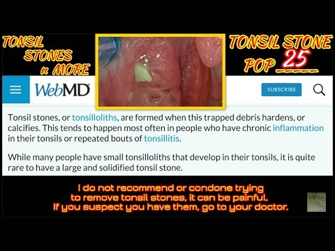 tonsil stone pop 25 - tonsil stone pop 25