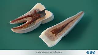 root canal treatment