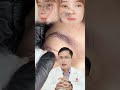 Nhấn mí plasma có hiệu quả không #bs_đình_dương #bsdinhduongthammy #lamdep 