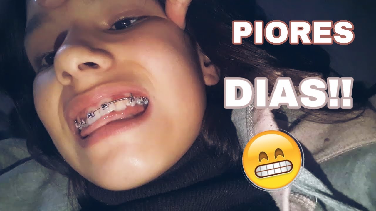 MEUS PRIMEIROS DIAS COM O APARELHO!! #DiárioDoMeuAparelhoOrtodôntico3