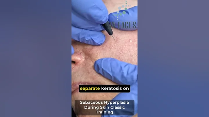Sebaceous Hyperplasia Skin Classic
