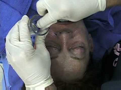 Minimally-Invasive Facial Rejuvenation: Techniques in Aesthetic Plastic Surgery (Elsevier)