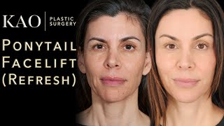 Ponytail Facelift Cost? Priceless! No One Knew She Had A Facelift (Until Now!) Before and After