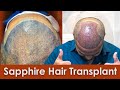 Sapphire hair transplant surgery review in nashik  grade 6 baldness  new roots clinic