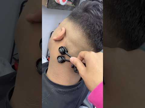 ازالة الحباية السوداء من الرقبة       