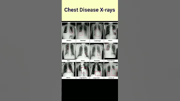 Chest Disease In X Ray Lungs Disease Defferent Chest X Ray Radiography Lungproblems 