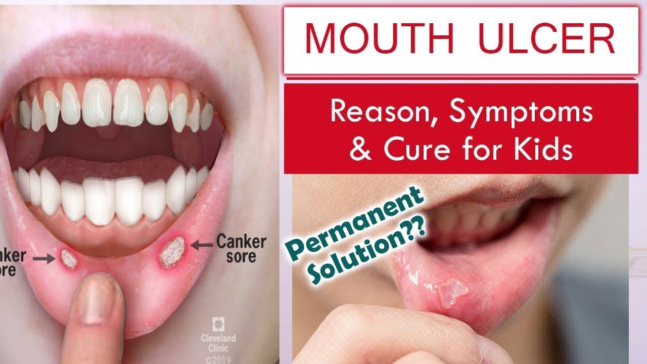 Useful treatment of mouth ulcers by eating hot food Let's Tweet About