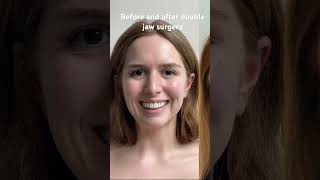 Double Jaw Surgery For Correction Of Overbite Retrognathia With Dr David Alfi Alfi Oral Surgery