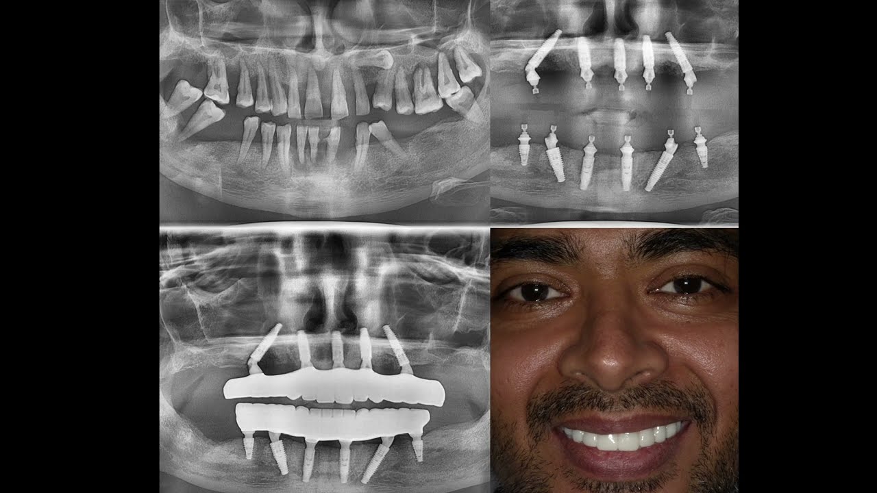 All On Four Implants Zirconia Teeth