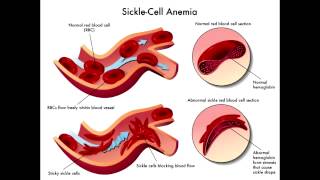 Sickle Cell Anemia