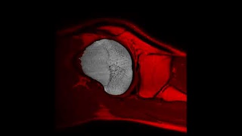 spatially varying statistical model: femur MRI segmentation sagittal 1mm slices