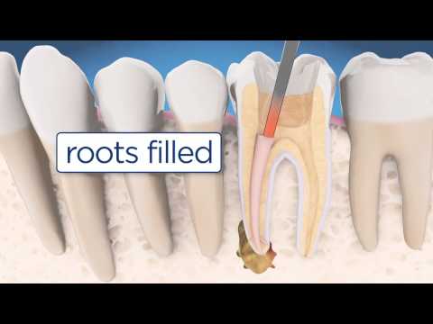 Video: Va acoperi asigurarea retratarea canalului radicular?