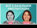 Базальная имплантация зубов – отзыв пациентки: плюсы и минусы!