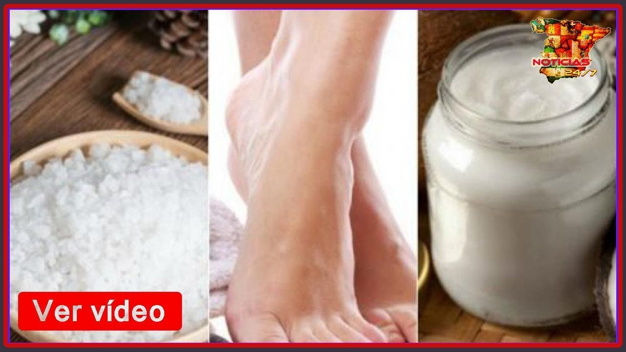 Cómo ablandar los callos de los pies con 5 remedios naturales YouTube