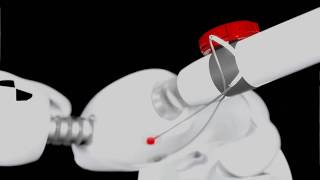 SHOULDER PACEMAKER™ platform | Revolution in shoulder treatment with Motion Activated Stimulation Profile