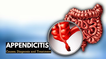 Appendicitis, Causes, Signs and Symptoms, Diagnosis and Treatment.