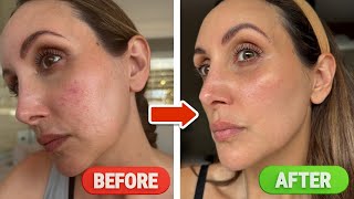 Acne vs Rosacea: What I Wish I Knew Sooner