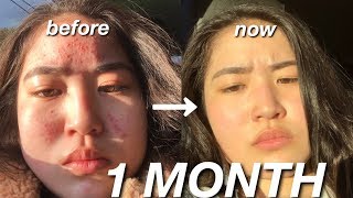 HOW I CLEARED MY SKIN IN A MONTH || skincare routine + acne journey with pictures