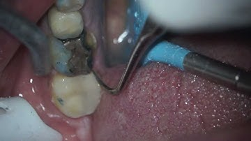 Refining a core backup on #18, video taken using a Seiler Microscope