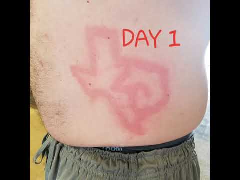 FREEZE BRANDING #2 - YouTube