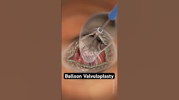 Eenvoudige ballonoperatie versus openhartoperatie (3D-animatie)