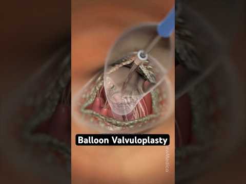 Simple balloon vs.