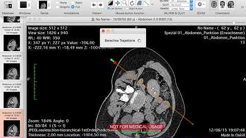 Trajectory Calculation of Puncture Needles in Computed Tomography Image Data