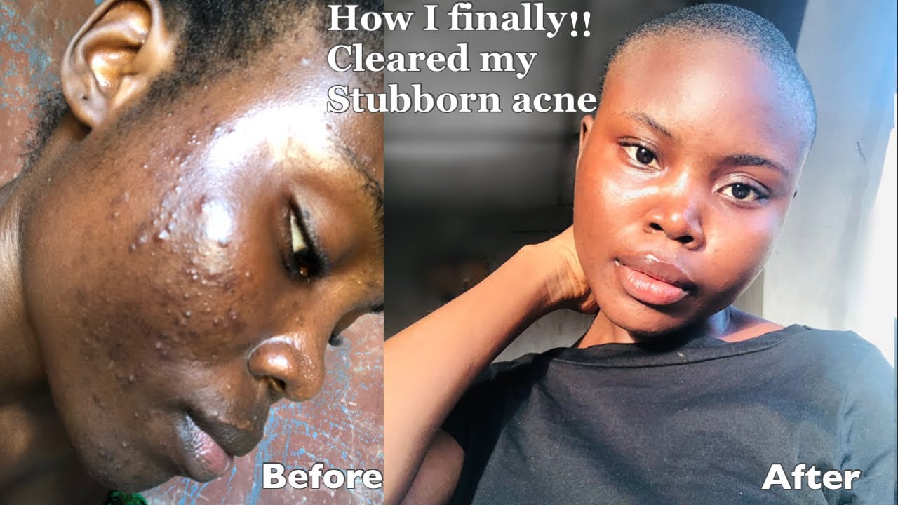 How I cleared my acne and dark spots(my acne of 4years!) realistic tips ...