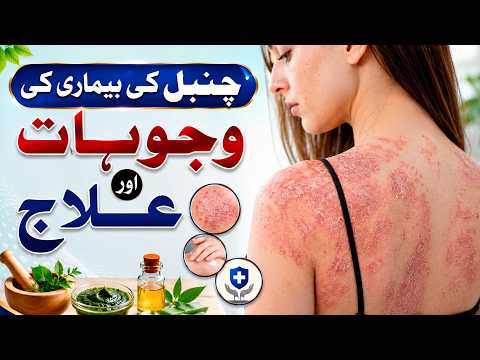 Chambal Ka ilaj- Kharish Ka ilaj- Garmi Dano Ka ilaj Allergy Ka ilaj- Skin Allergy Treatment at Home